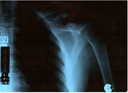 01 wszystko jasne obojczyk do wymiany