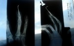 zdjecie rentgenowskie palca fragmenta