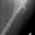 Wypadek motocyklowy bez znieczulenia - rentgen