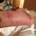 Casey Stoner juz po operacji kostki - Kostka stonera USA