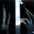 Wheelieholix Triumph sezon pelen wrazen - zdjecie rentgenowskie palca fragmenta