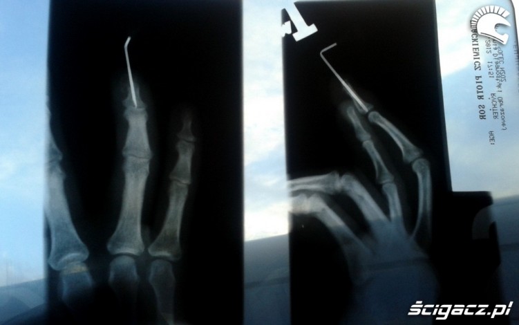 zdjecie rentgenowskie palca fragmenta