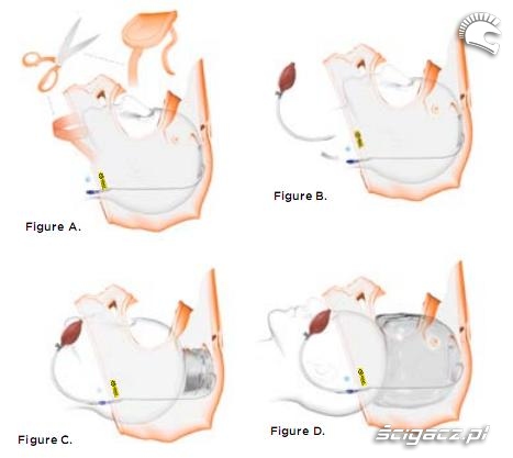 Eject Helmet Removal System