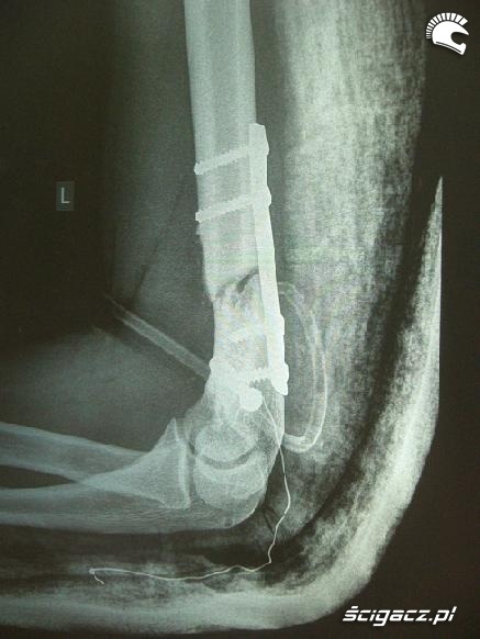 Zlamanie stawu lokciowego